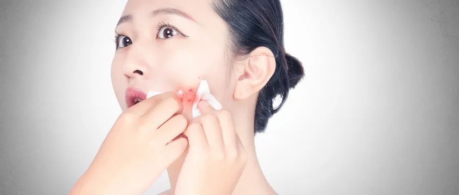 如何預(yù)防粉刺的發(fā)生和痤瘡的形成？