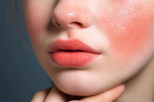 秋季皮膚為什么容易過敏？