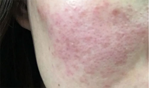 皮膚泛紅癢是什么原因？皮膚紅癢怎么回事？