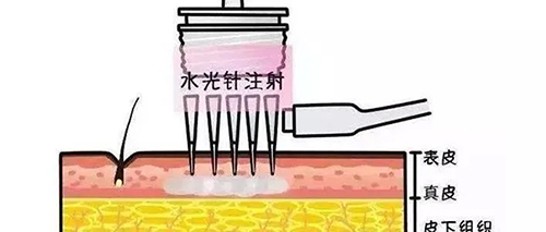 水光針的類型有哪幾種？