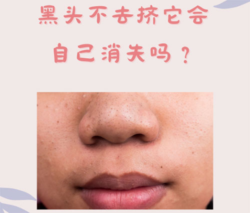 什么是黑頭？怎樣預(yù)防黑頭的形成？