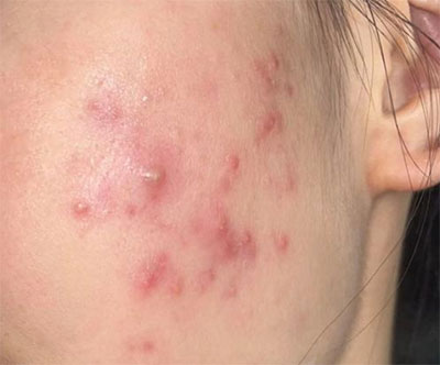 油痘肌和油敏肌怎么區(qū)分？油痘肌和油敏肌的區(qū)別！