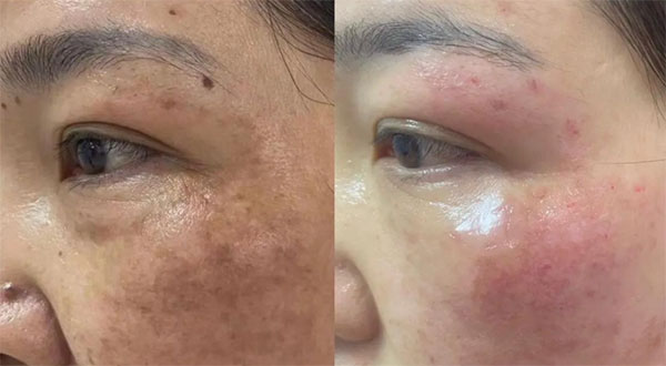 祛斑后為什么會反黑？祛斑后會反黑是什么原因？