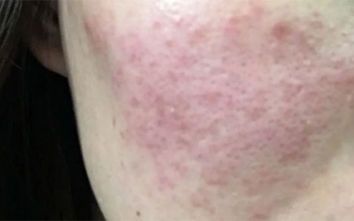 皮膚泛紅癢是什么原因？皮膚紅癢怎么回事？