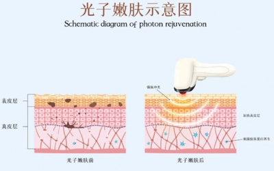 光子嫩膚術(shù)前注意事項(xiàng)有哪些？